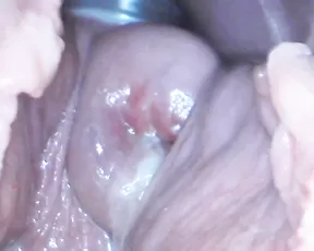 Milly17 cervix penetration & speculum premium free manyvids liveporn livesex1