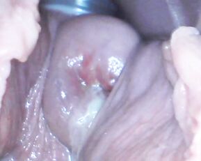 Milly17 cervix penetration & speculum premium free manyvids liveporn livesex1